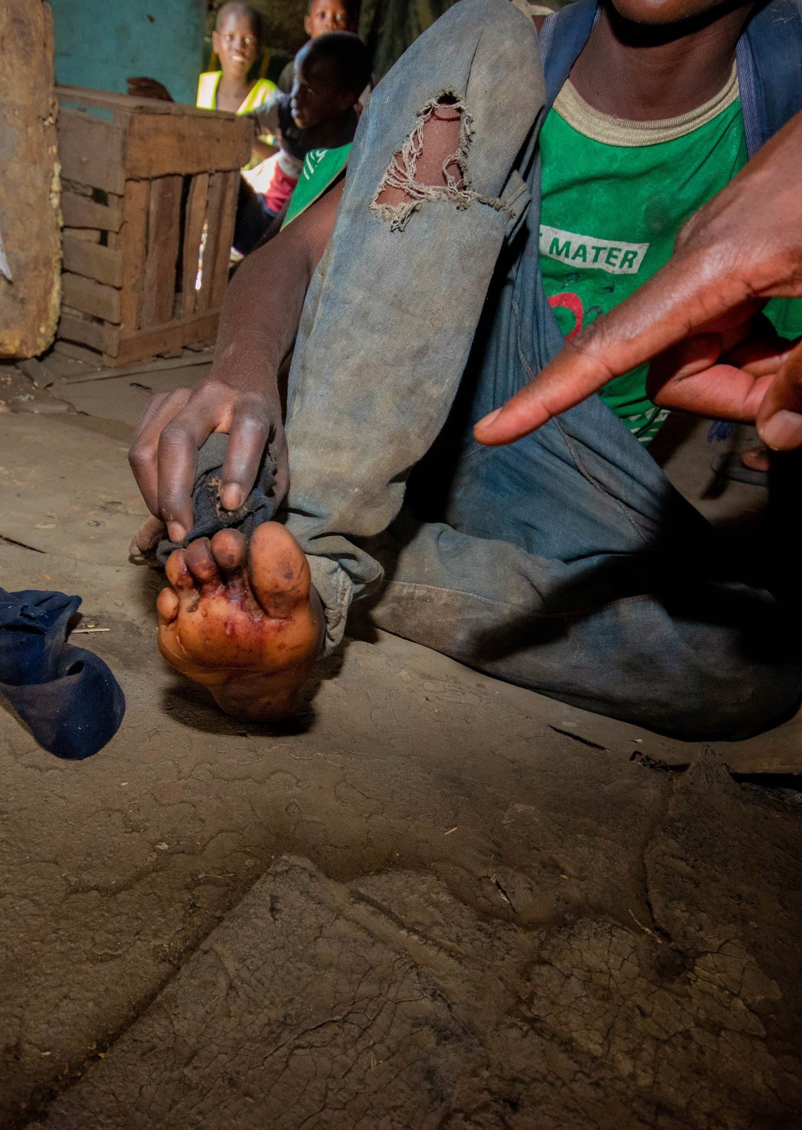 An untreated foot injury — the kind of medical need our healthcare programme responds to